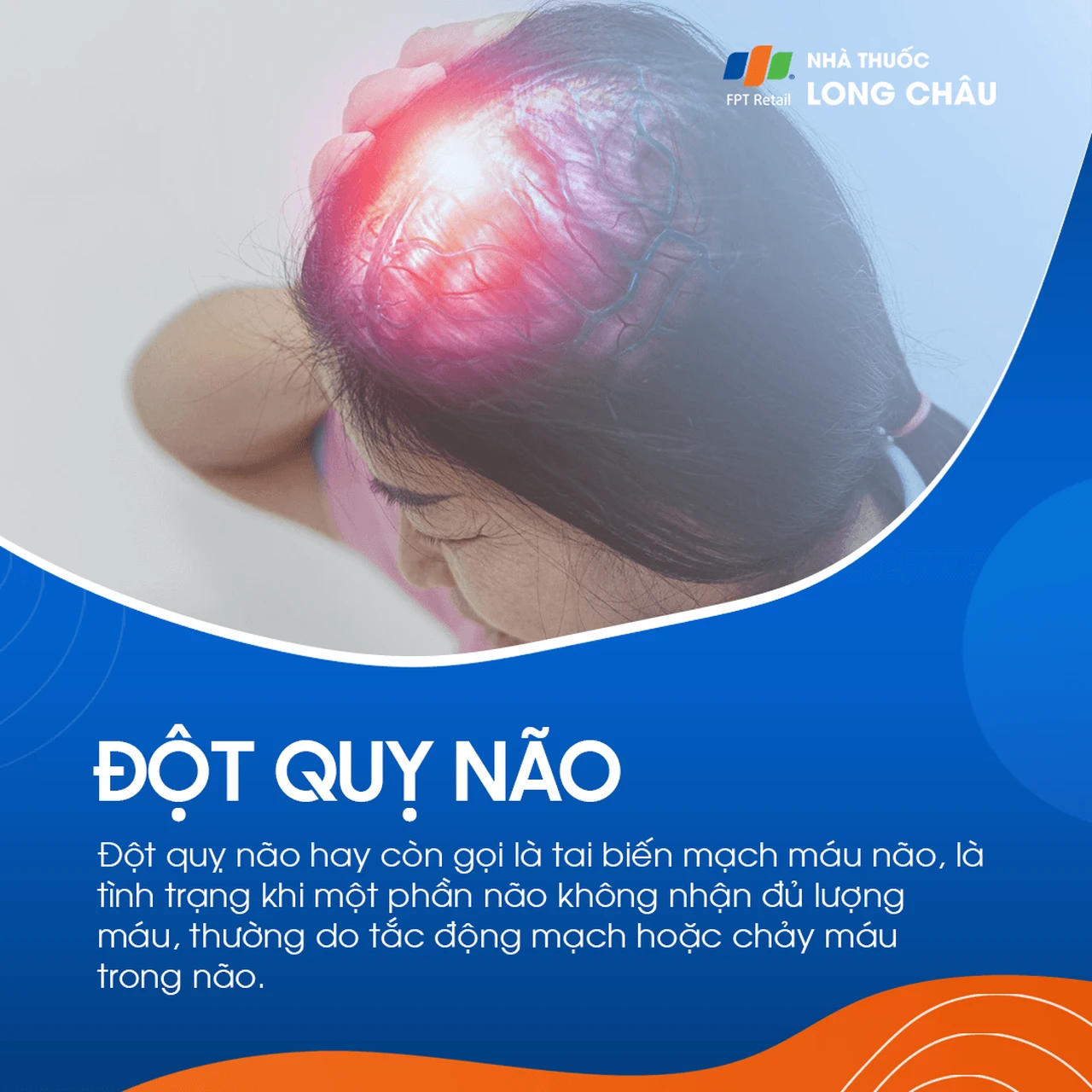 Đột quỵ não 1