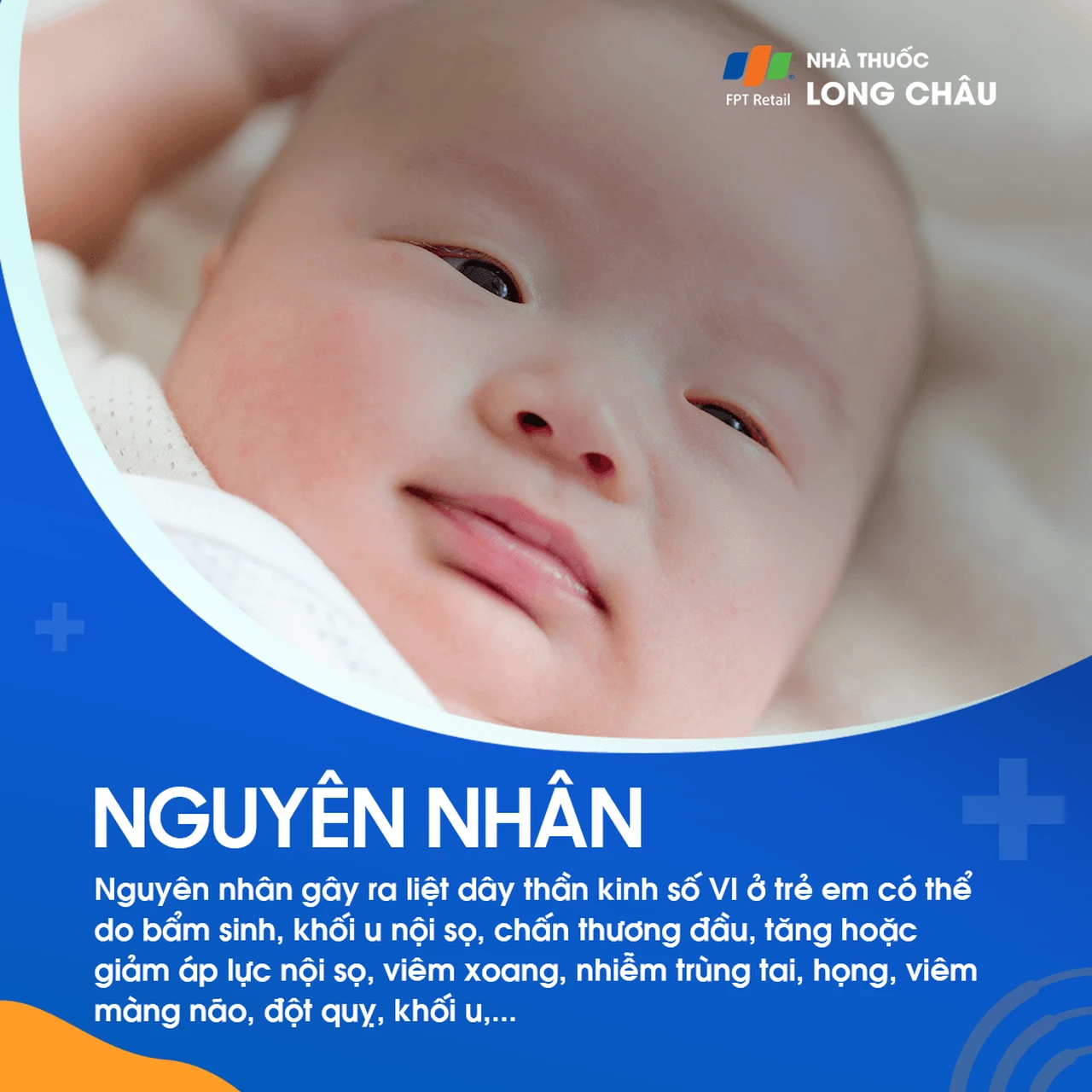 Liệt dây thần kinh số VI 3