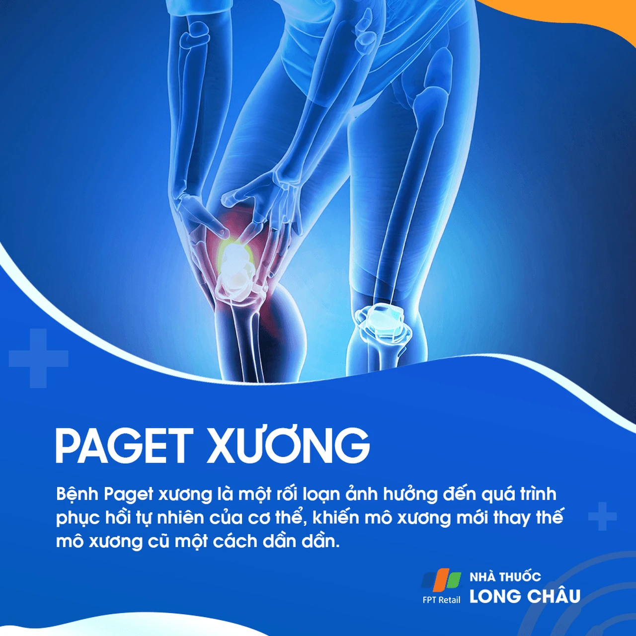 paget xương 1