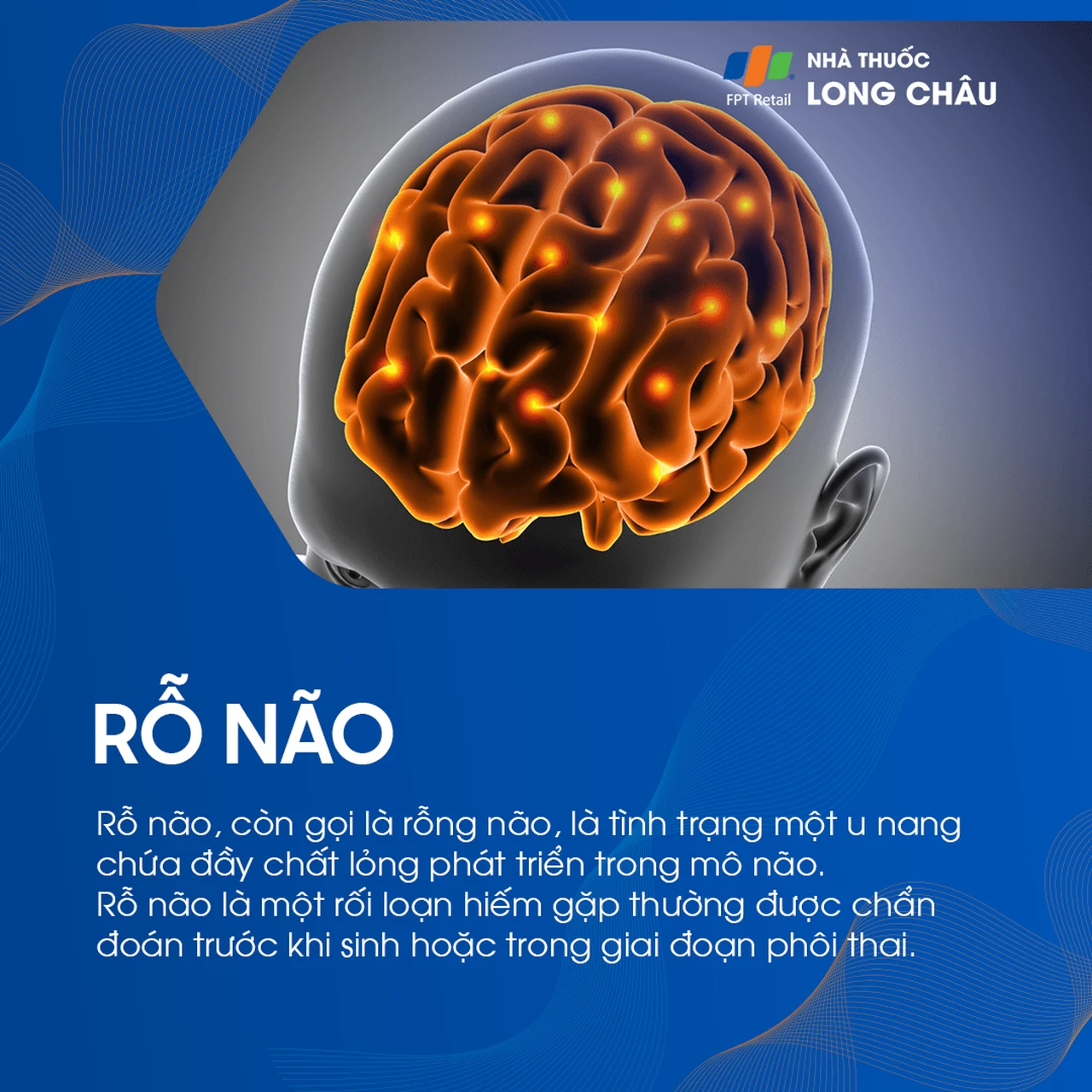 Rỗ não 1