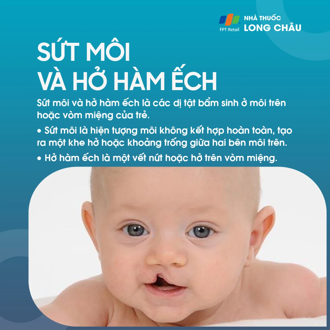 Sứt môi và hở hàm ếch 1