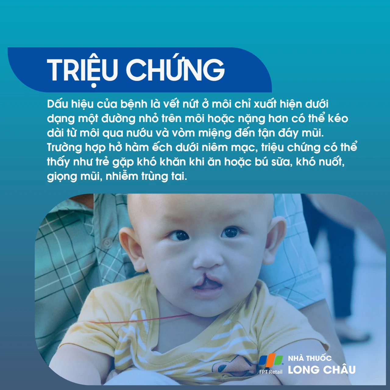 Sứt môi và hở hàm ếch 2