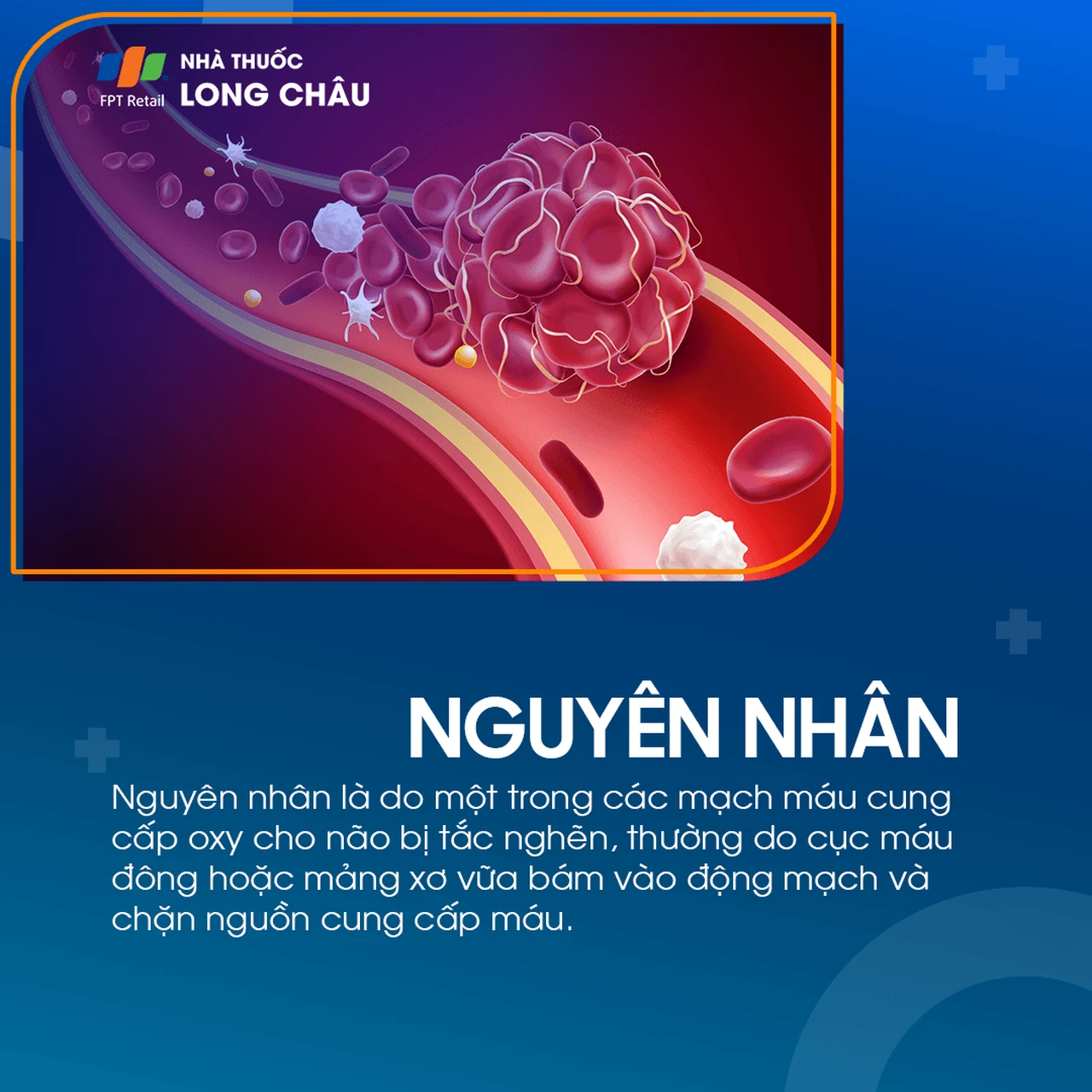 Cơn thiếu máu não cục bộ thoáng qua 3