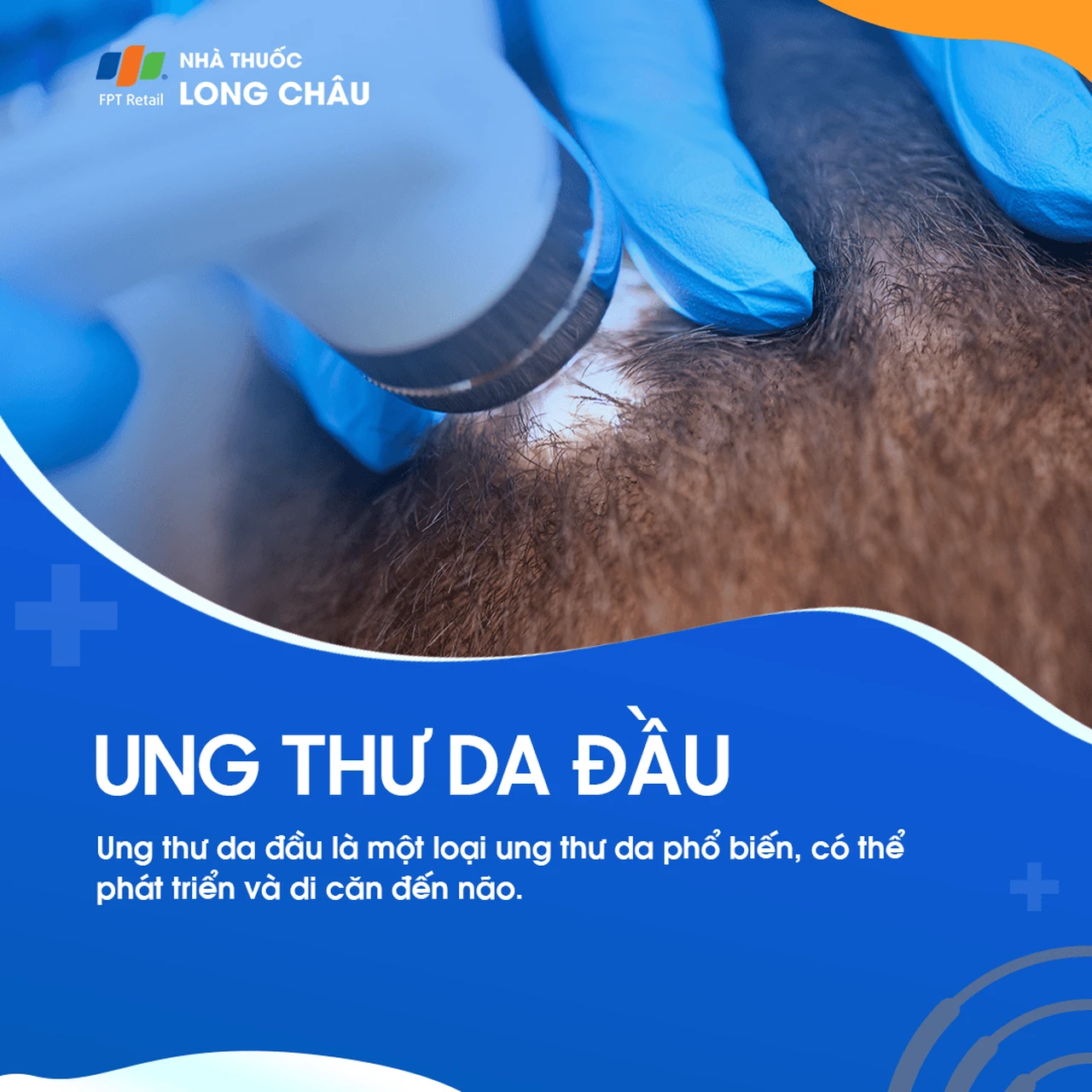 Ung thư da đầu 1