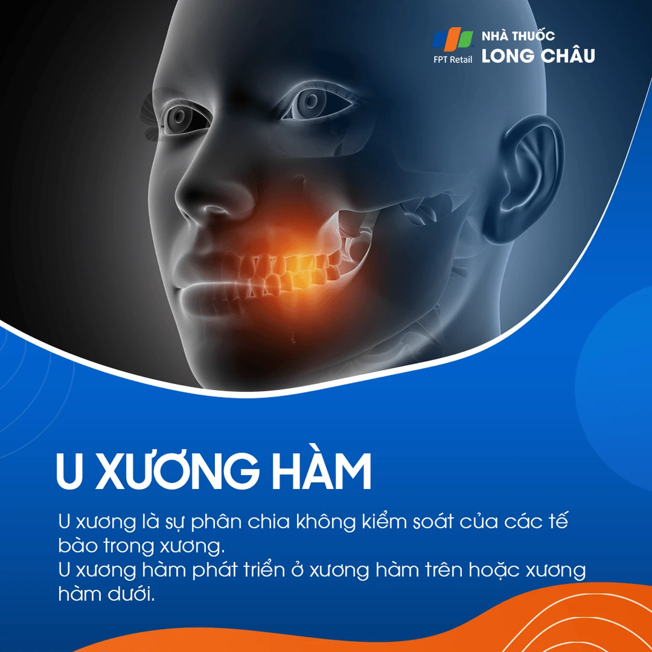 U xương hàm 1