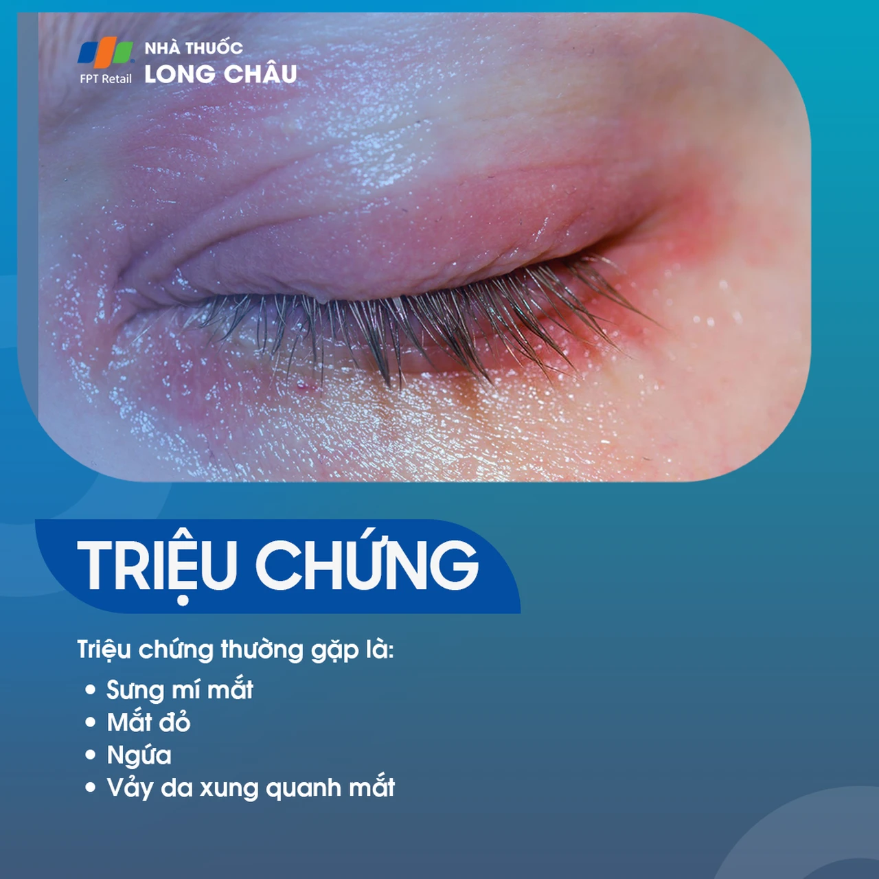  Viêm bờ trên mi mắt là gì? Nguyên nhân, triệu chứng và cách điều trị 2