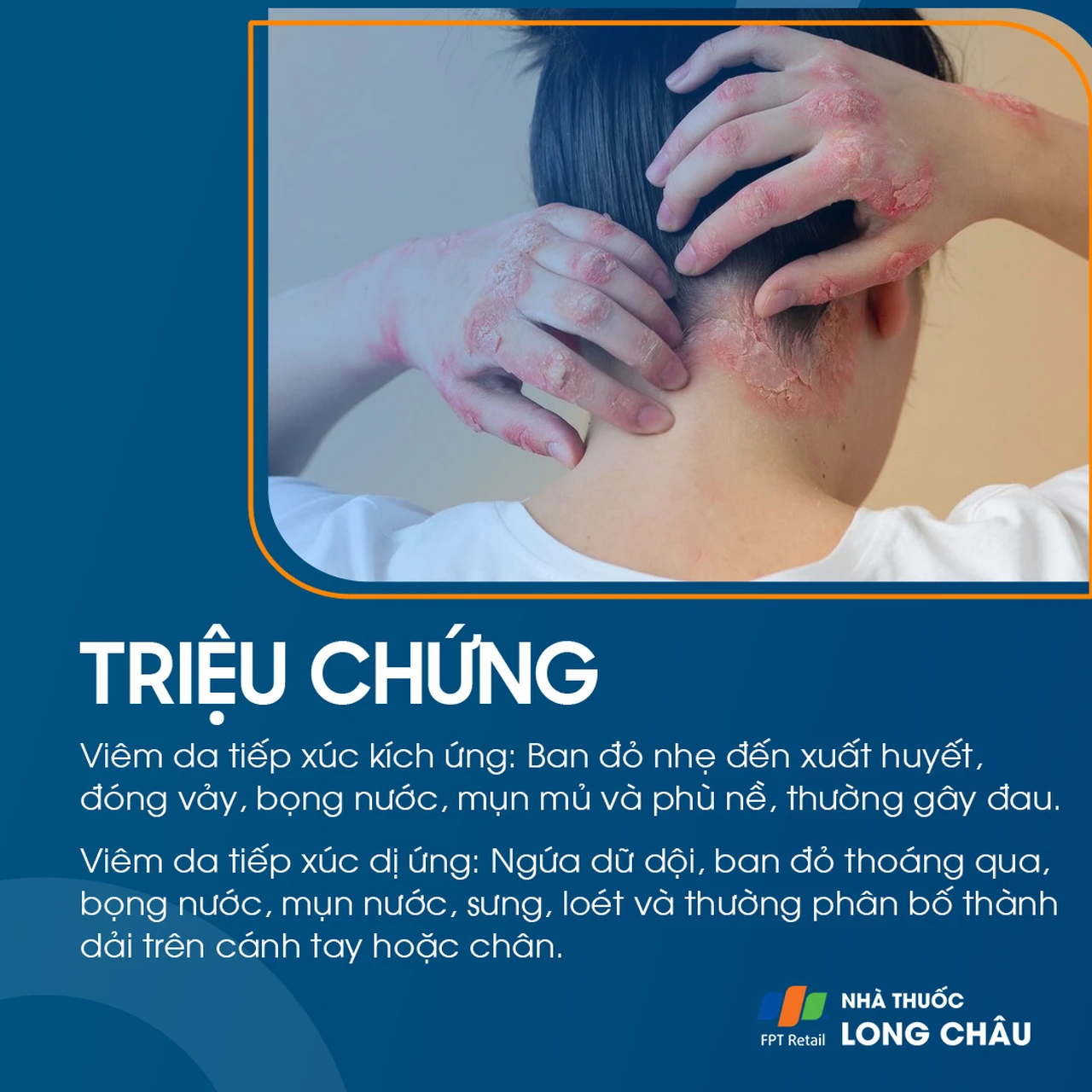 Triệu chứng viêm da do tiếp xúc với da đỏ, ngứa và phát ban