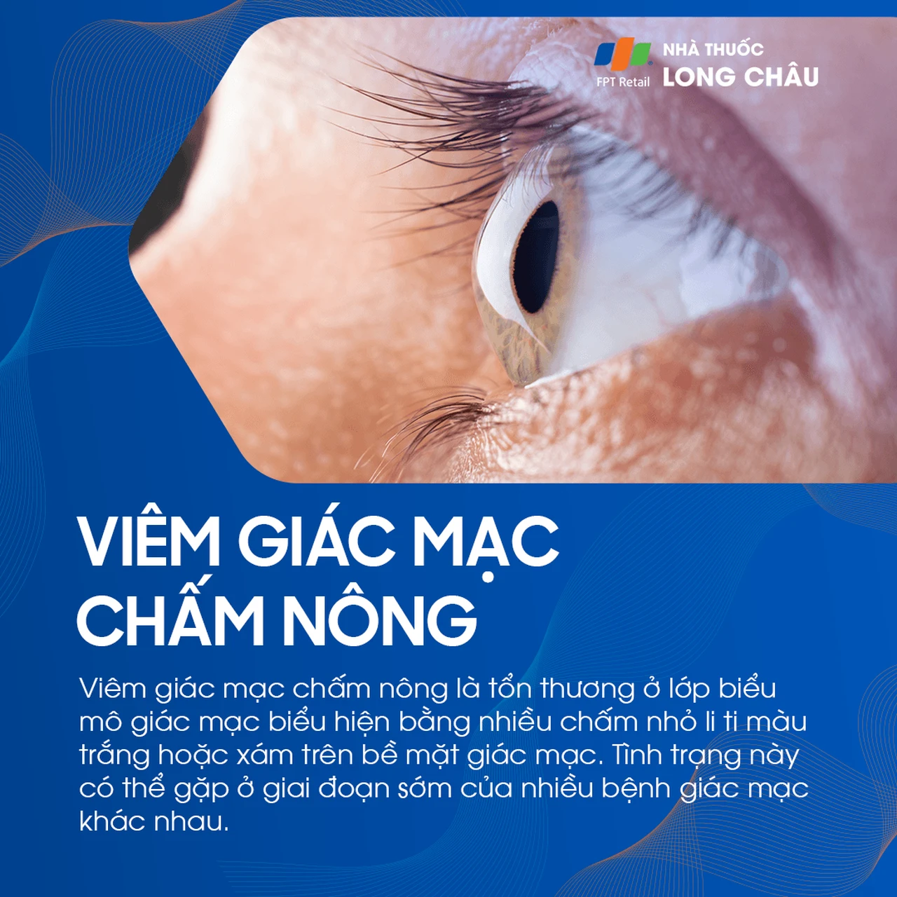 Viêm giác mạc chấm nông 1