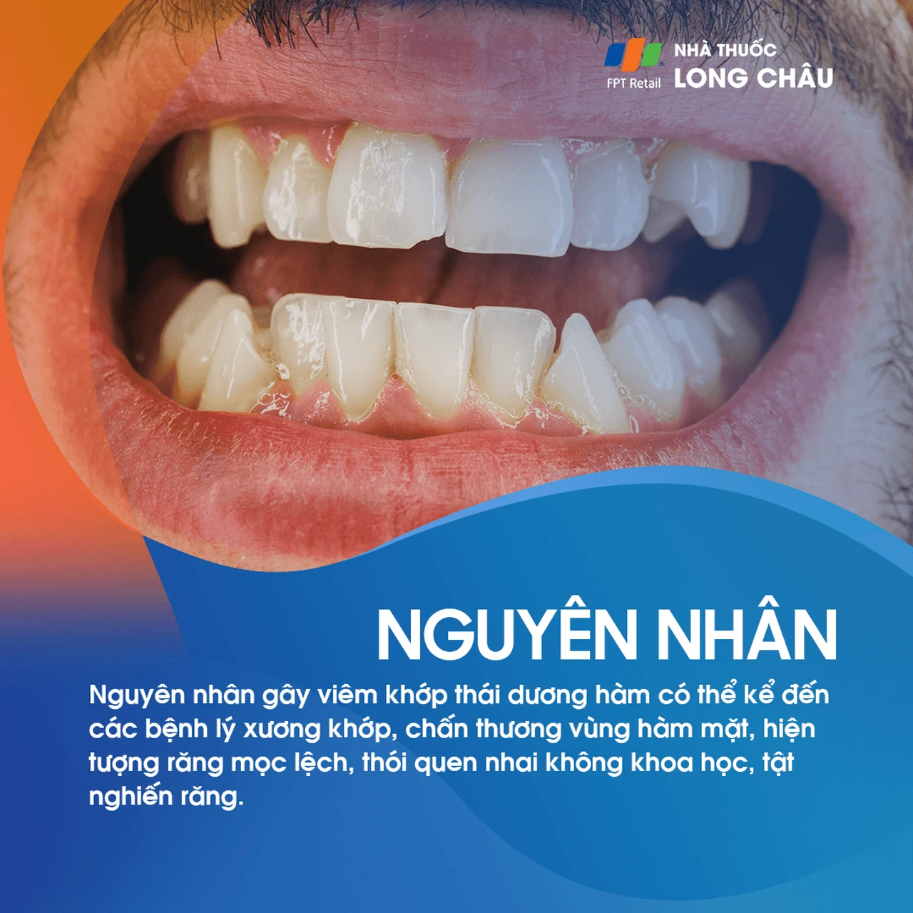 Viêm khớp thái dương hàm 3