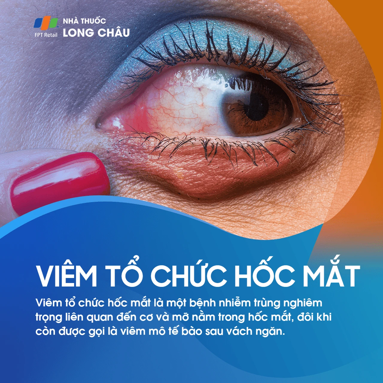 Viêm tổ chức hốc mắt 1