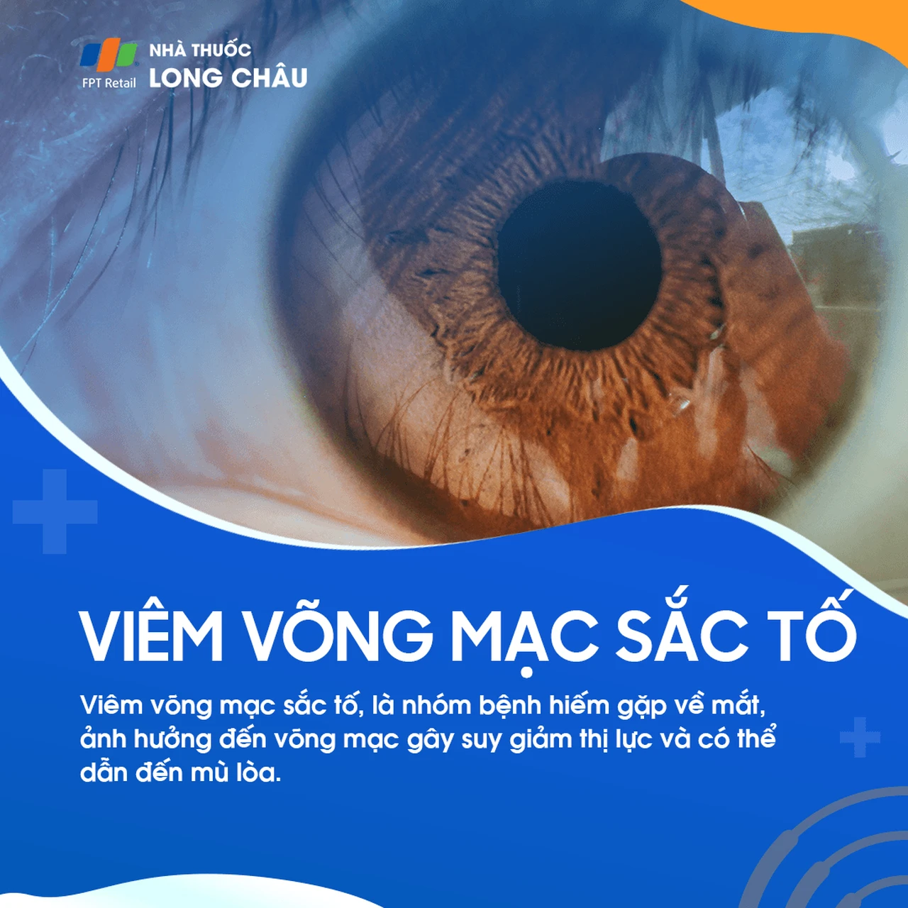 Viêm võng mạc sắc tố 1