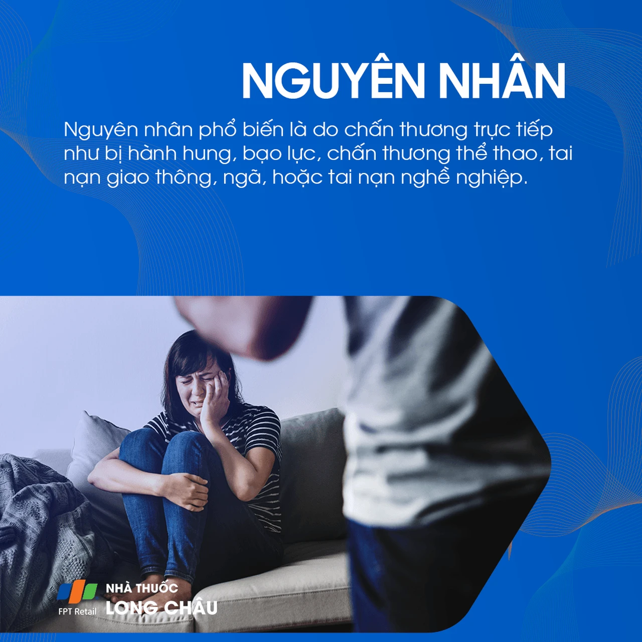 Vỡ xương hốc mắt 2