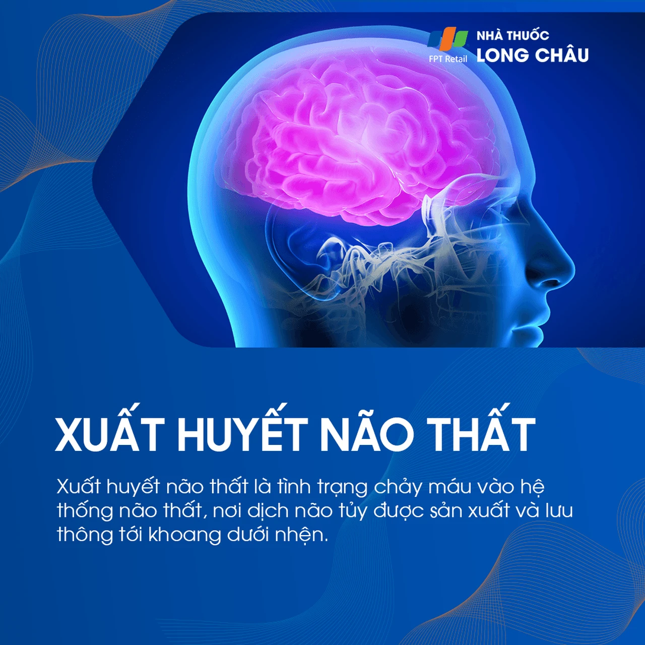 Xuất huyết não thất 1