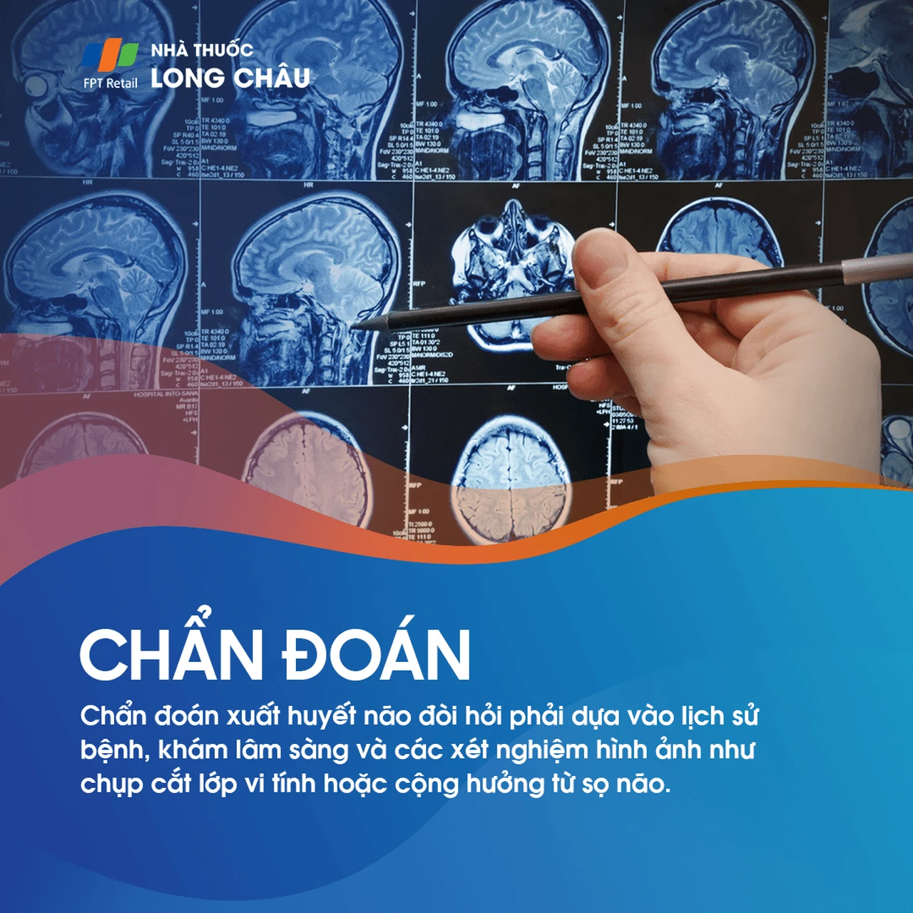 Xuất huyết não 5