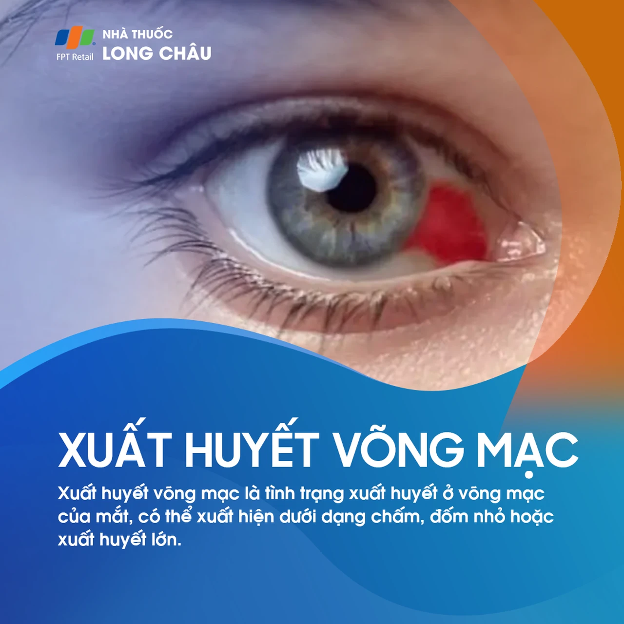 Xuất huyết võng mạc 1
