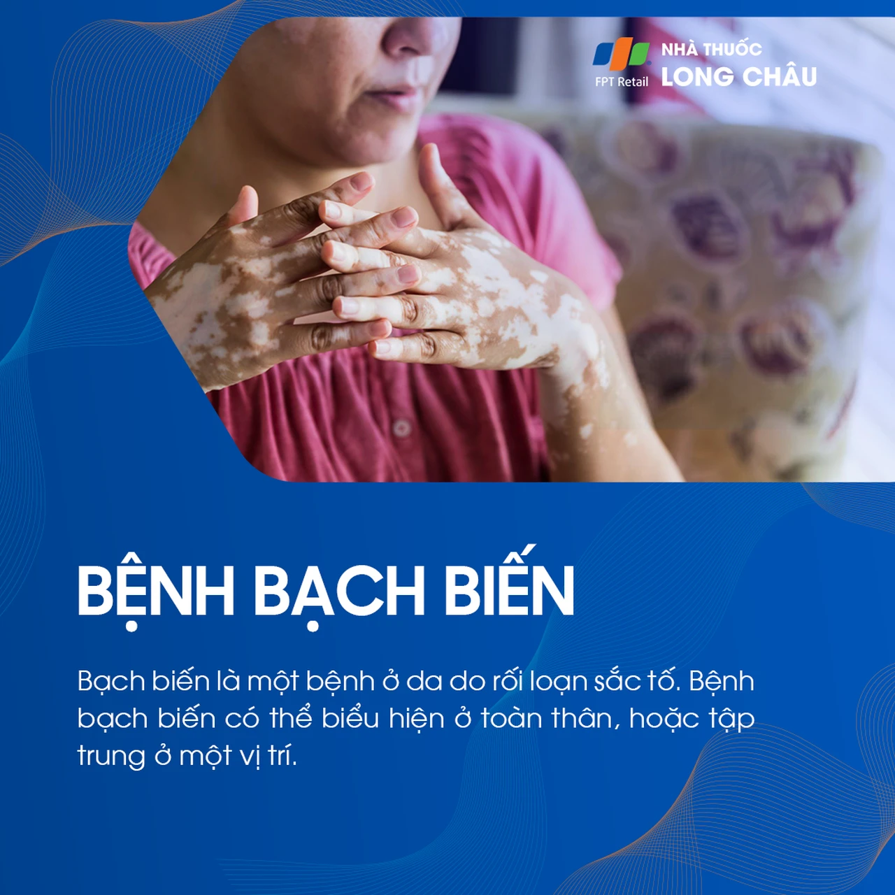 Bạch biến là bệnh da do rối loạn sắc tố, có thể xuất hiện toàn thân hoặc cục bộ