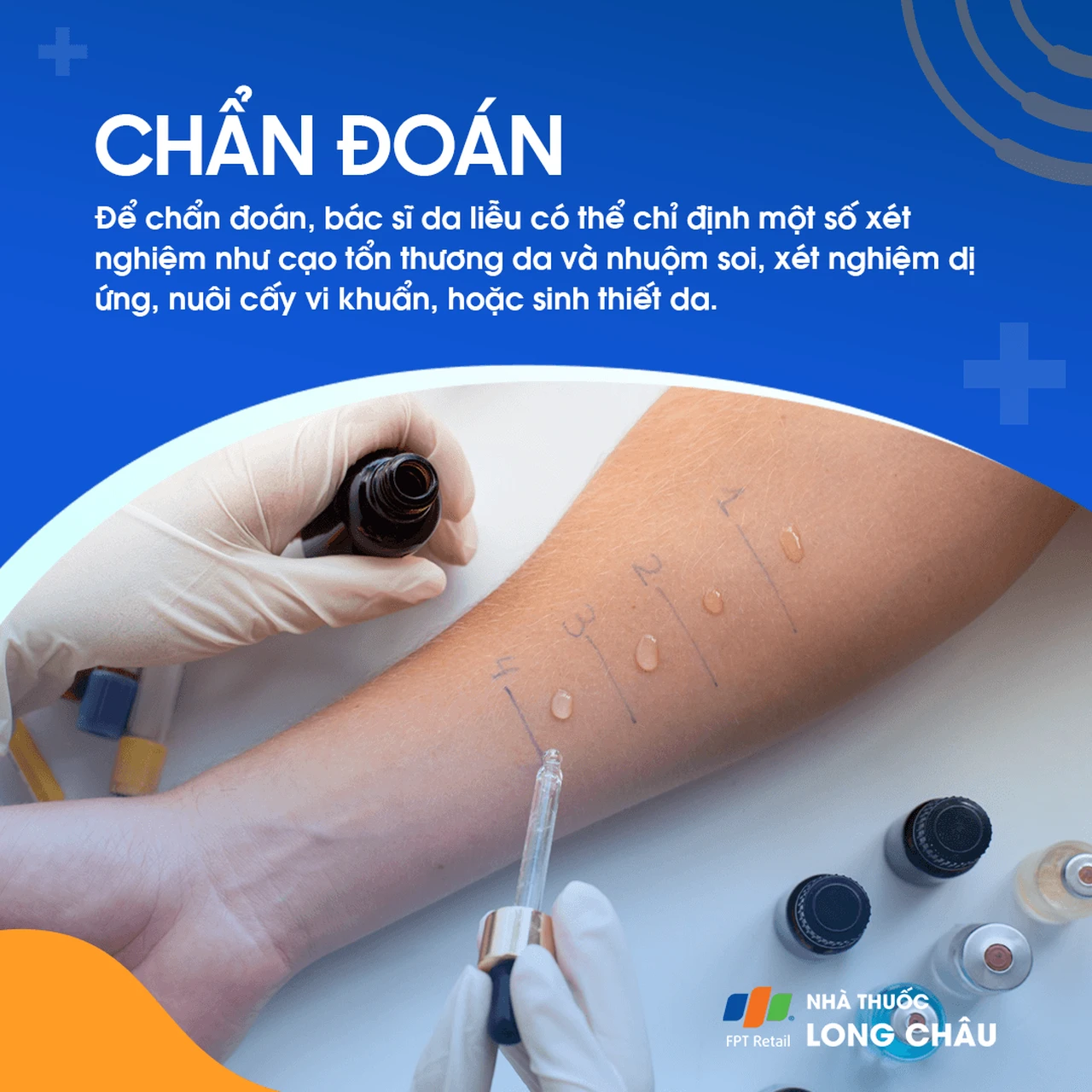 Chẩn đoán thường dựa vào kiểm tra lâm sàng và thử nghiệm da để xác định các yếu tố dị ứng gây ra