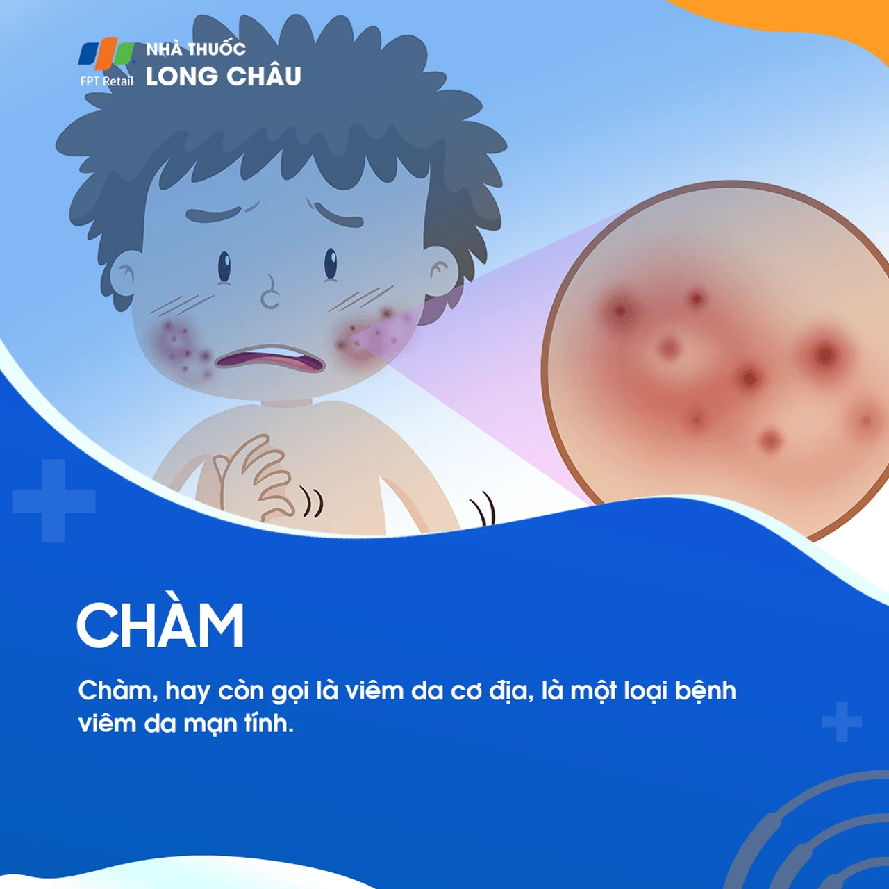 Chàm (viêm da cơ địa) là bệnh viêm da mạn tính, thường gây ngứa