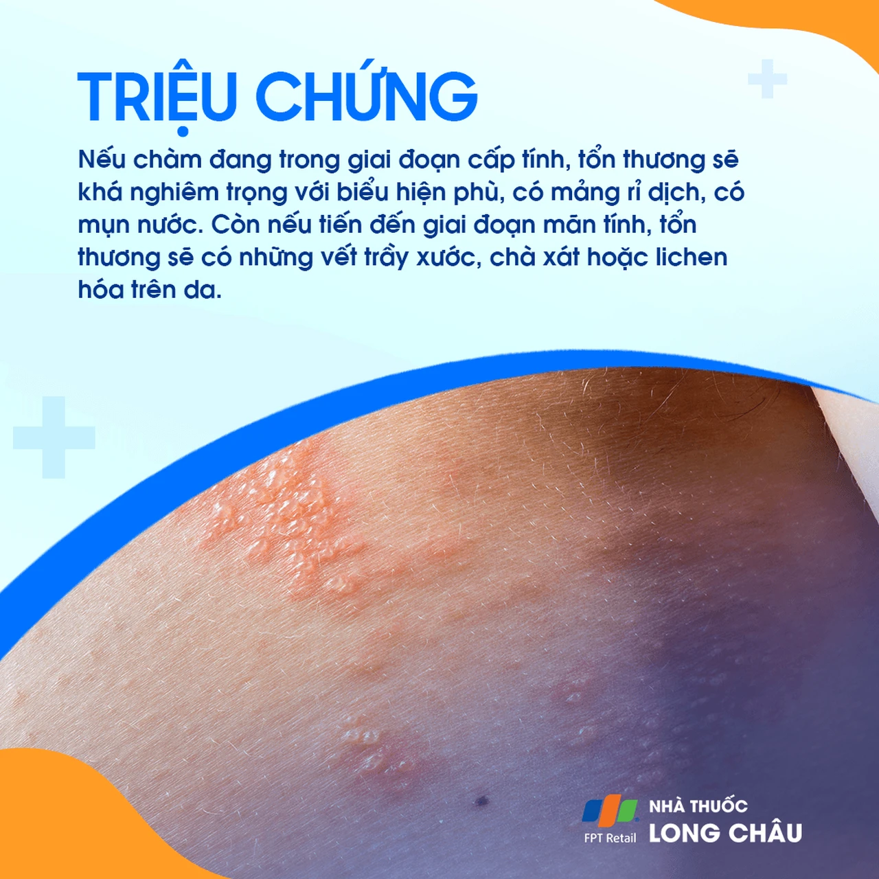 Triệu chứng chàm tùy theo giai đoạn: cấp tính có mụn nước, rỉ dịch, phù nề; mạn tính có trầy xước, khô da, lichen hóa