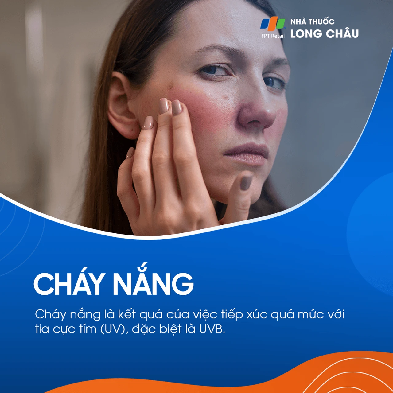 Cháy nắng được đặc trưng bởi ban đỏ, đôi khi và đau và phồng rộp do tiếp xúc với tia cực tím quá nhiều