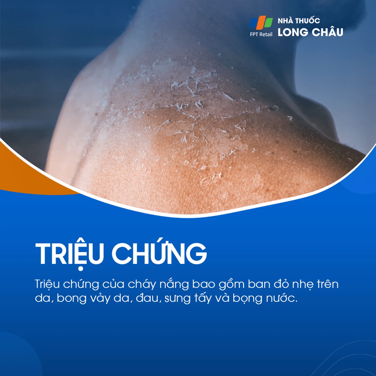 Triệu chứng da đỏ và bỏng rát do cháy nắng sau khi tiếp xúc dài lâu với ánh nắng mặt trời