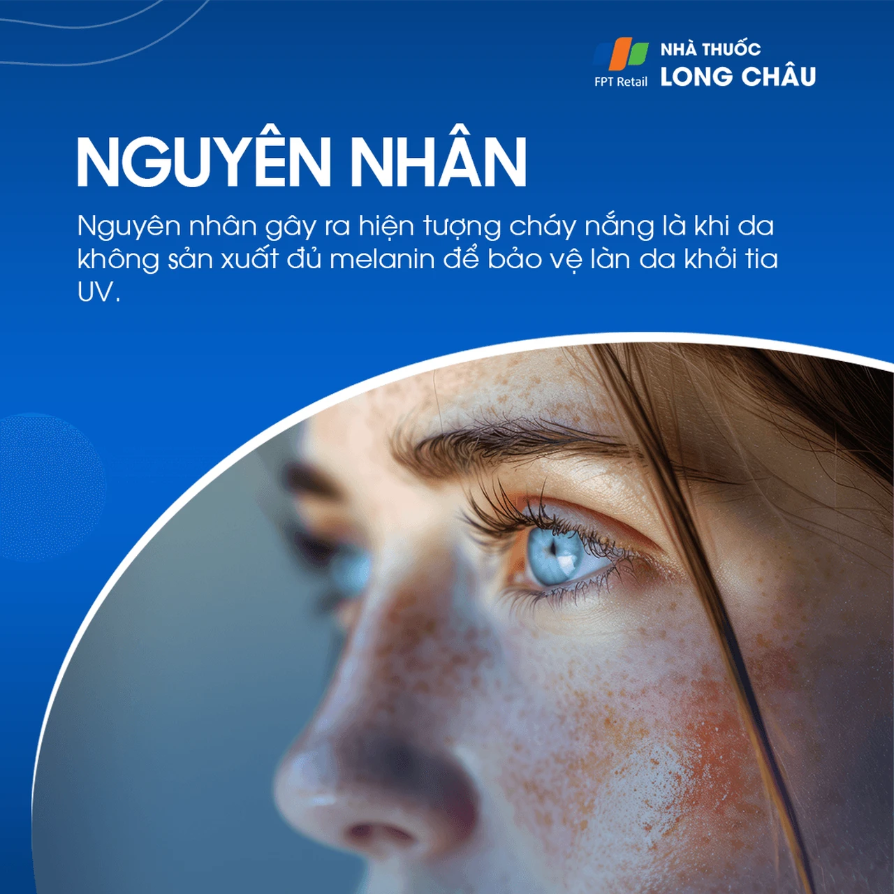 Nguyên nhân cháy nắng thường gặp nhất là do không sử dụng kem chống nắng