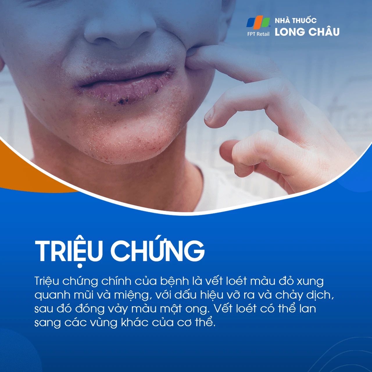 Vết loét đỏ quanh mũi, miệng – dễ vỡ, chảy dịch rồi đóng vảy màu mật ong, có thể lan sang vùng khác