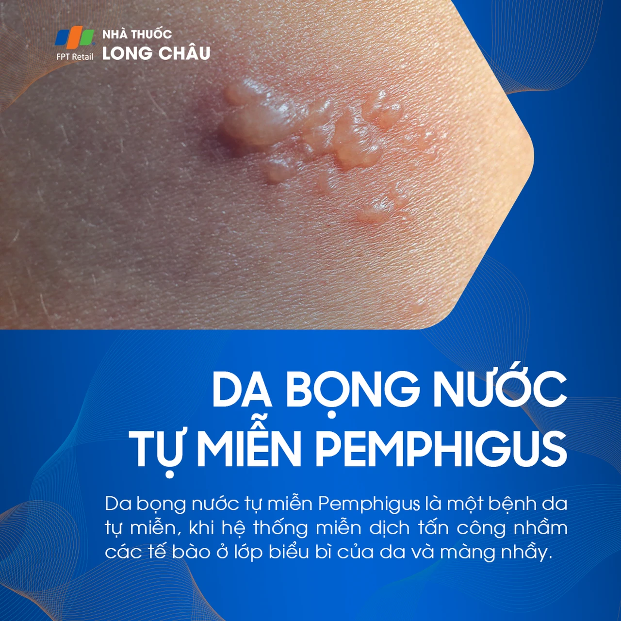 Da bọng nước tự miễn Pemphigus 1