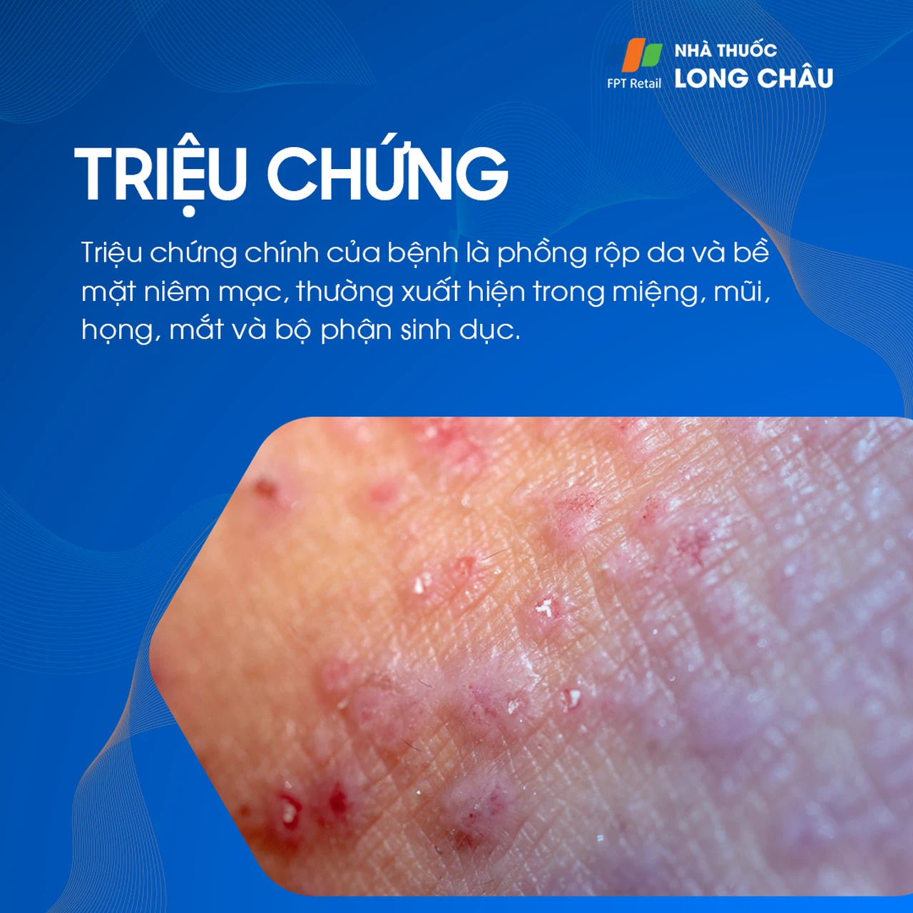 Da bọng nước tự miễn Pemphigus 2