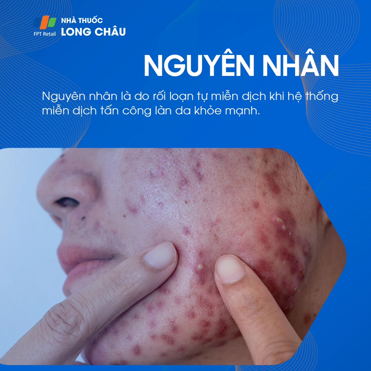 Da bọng nước tự miễn Pemphigus 3