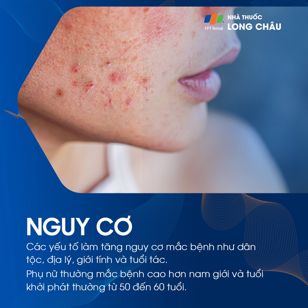 Da bọng nước tự miễn Pemphigus 4