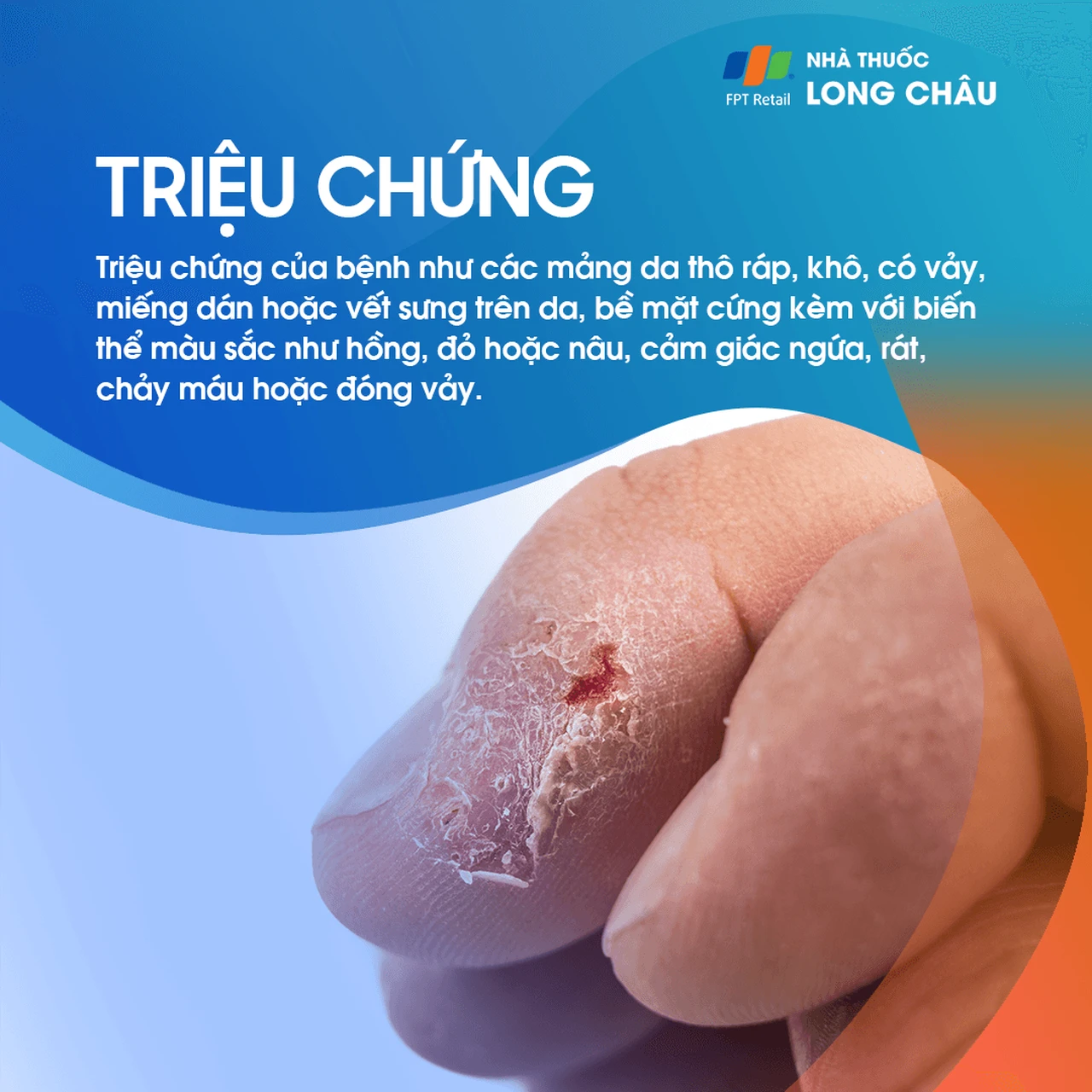 Dày sừng ánh sáng2