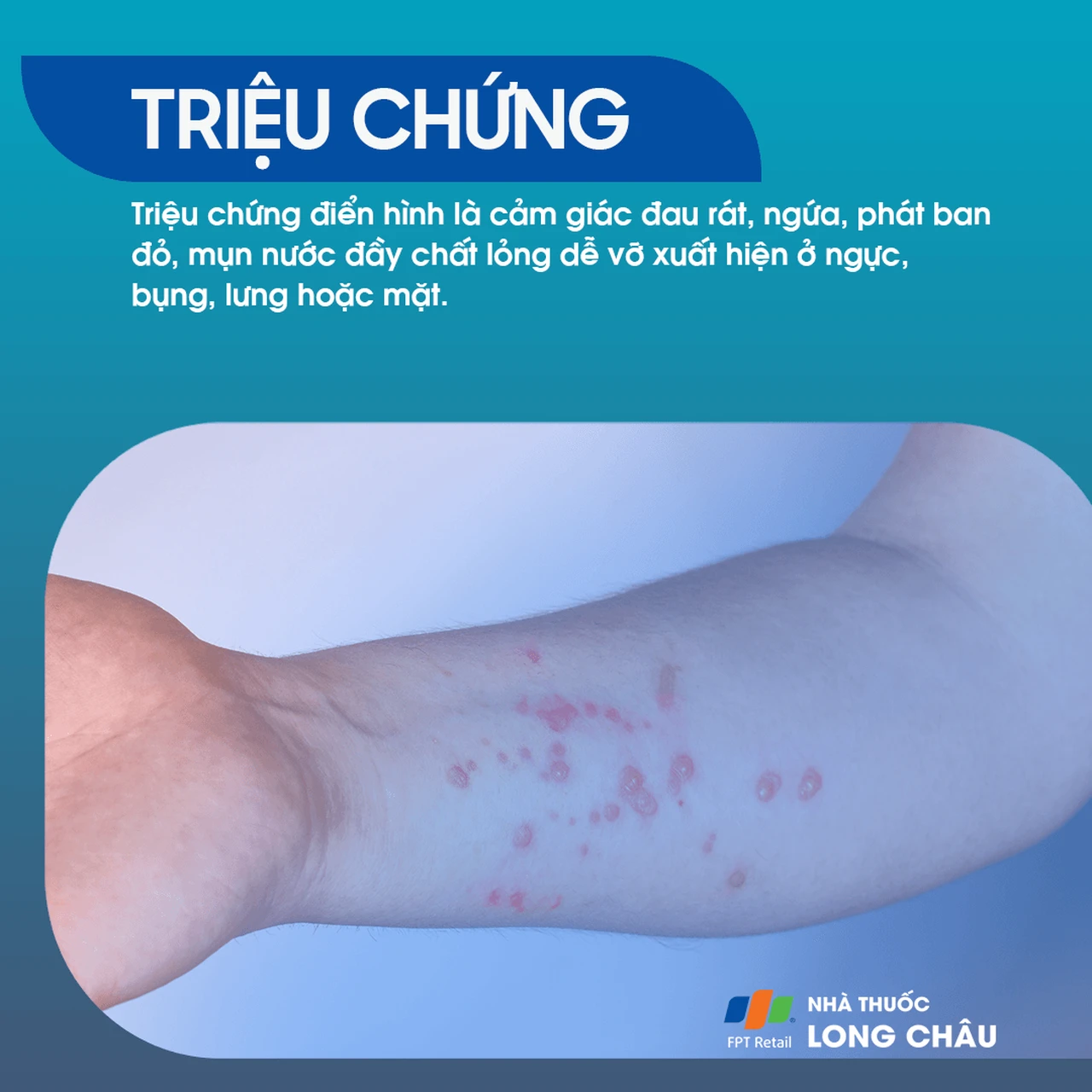  Triệu chứng bệnh giời leo, với các mảng phát ban đỏ và bóng nước gây ngứa trên cơ thể