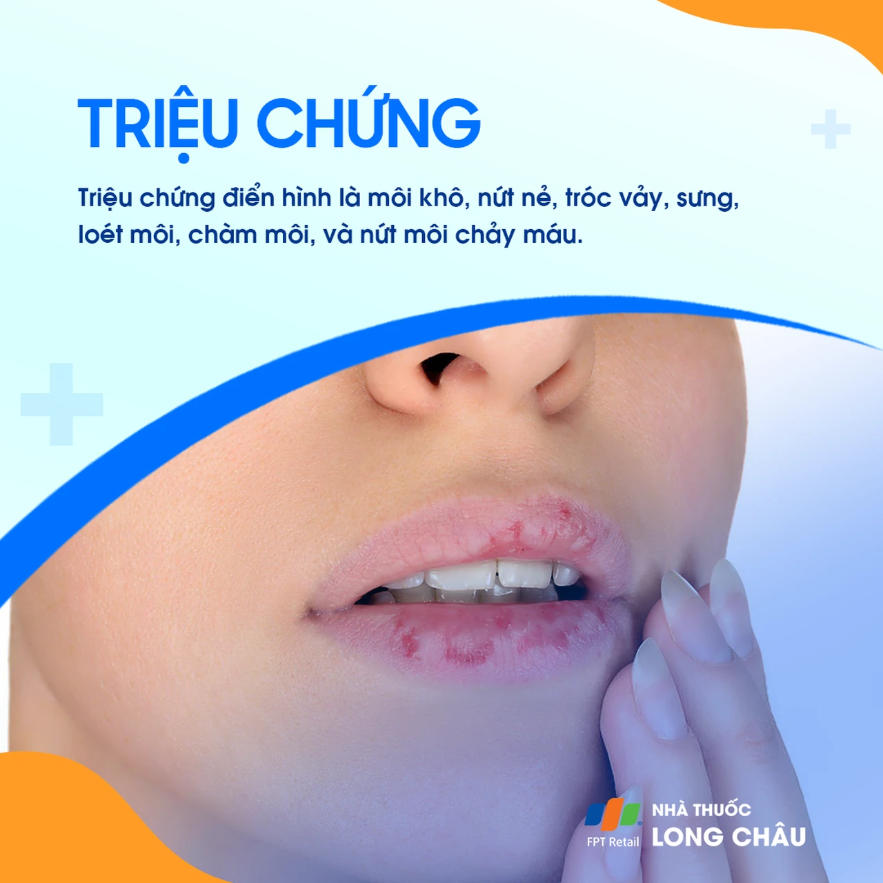 Triệu chứng của tình trạng khô môi bao gồm nứt nẻ và bong tróc