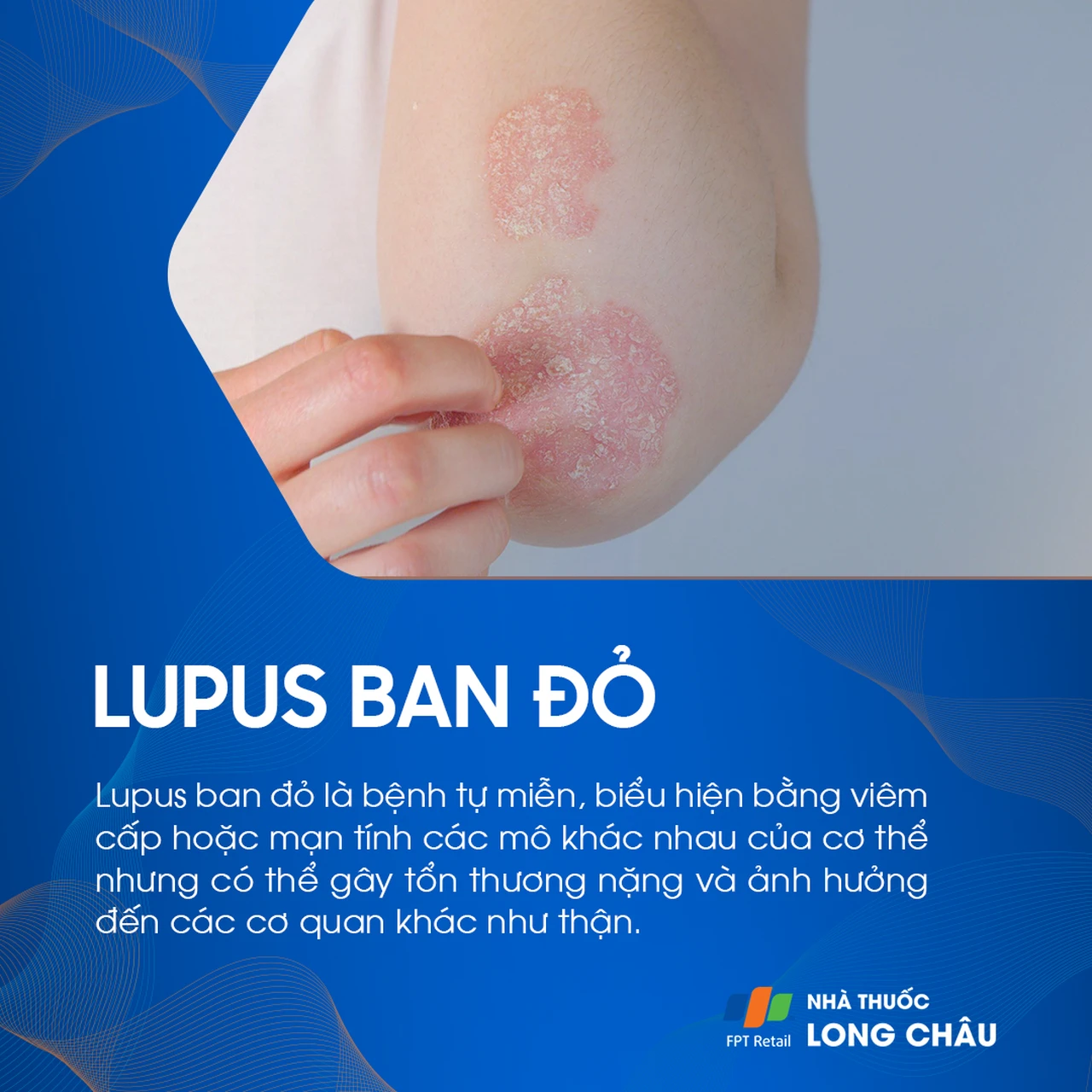 Tổn thương lupus ban đỏ trên vùng da tay – bệnh tự miễn gây viêm mô