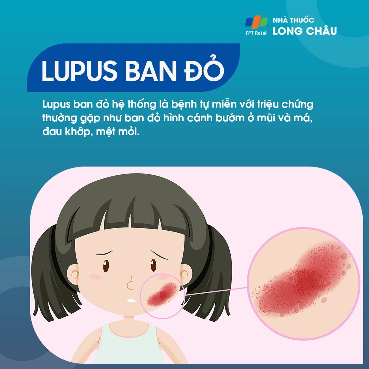 Lupus Ban Đỏ Hệ Thống 1