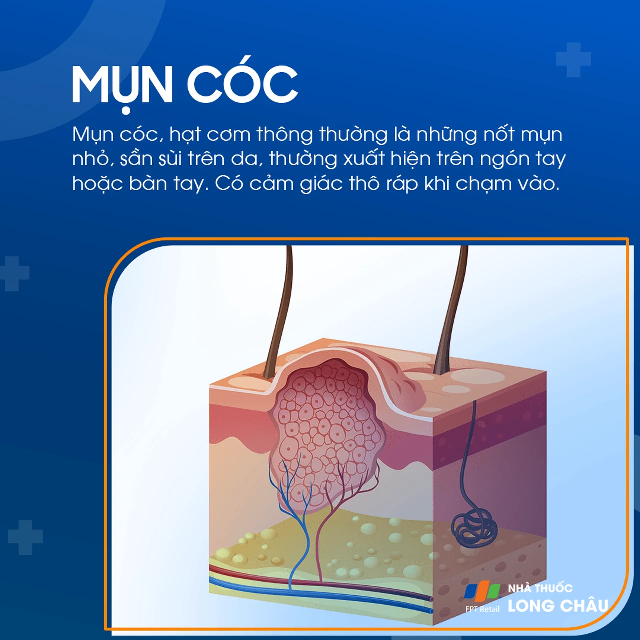 Mụn cóc thường trên ngón tay – tổn thương da sần sùi do virus HPV