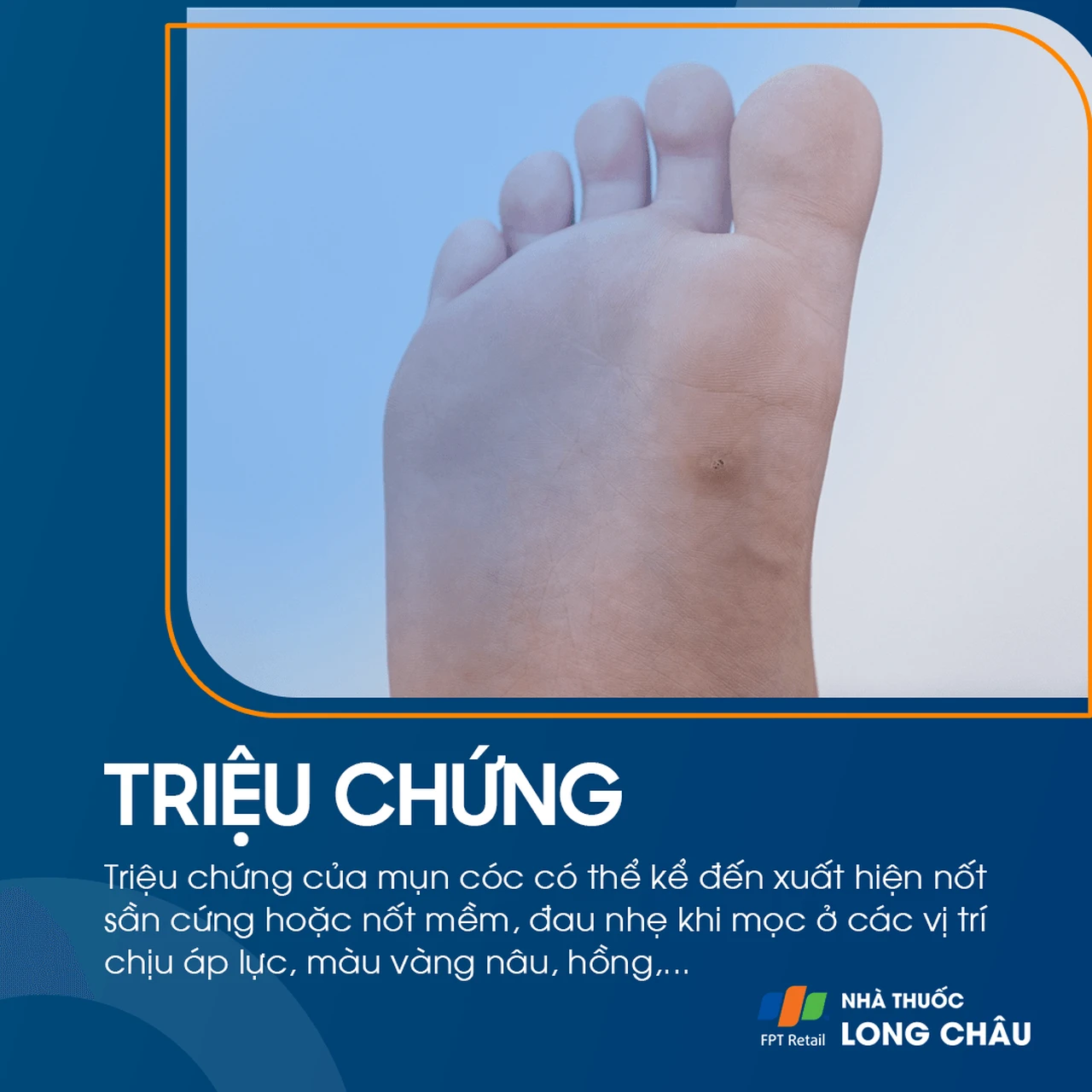 Mụn cóc ở lòng bàn chân – mụn lõm, có chấm đen ở giữa, gây đau khi di chuyển