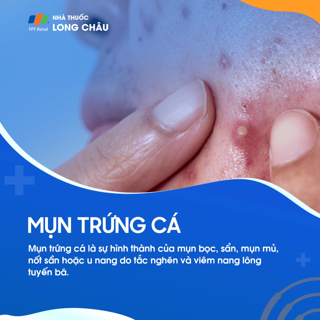 Mụn trứng cá 1