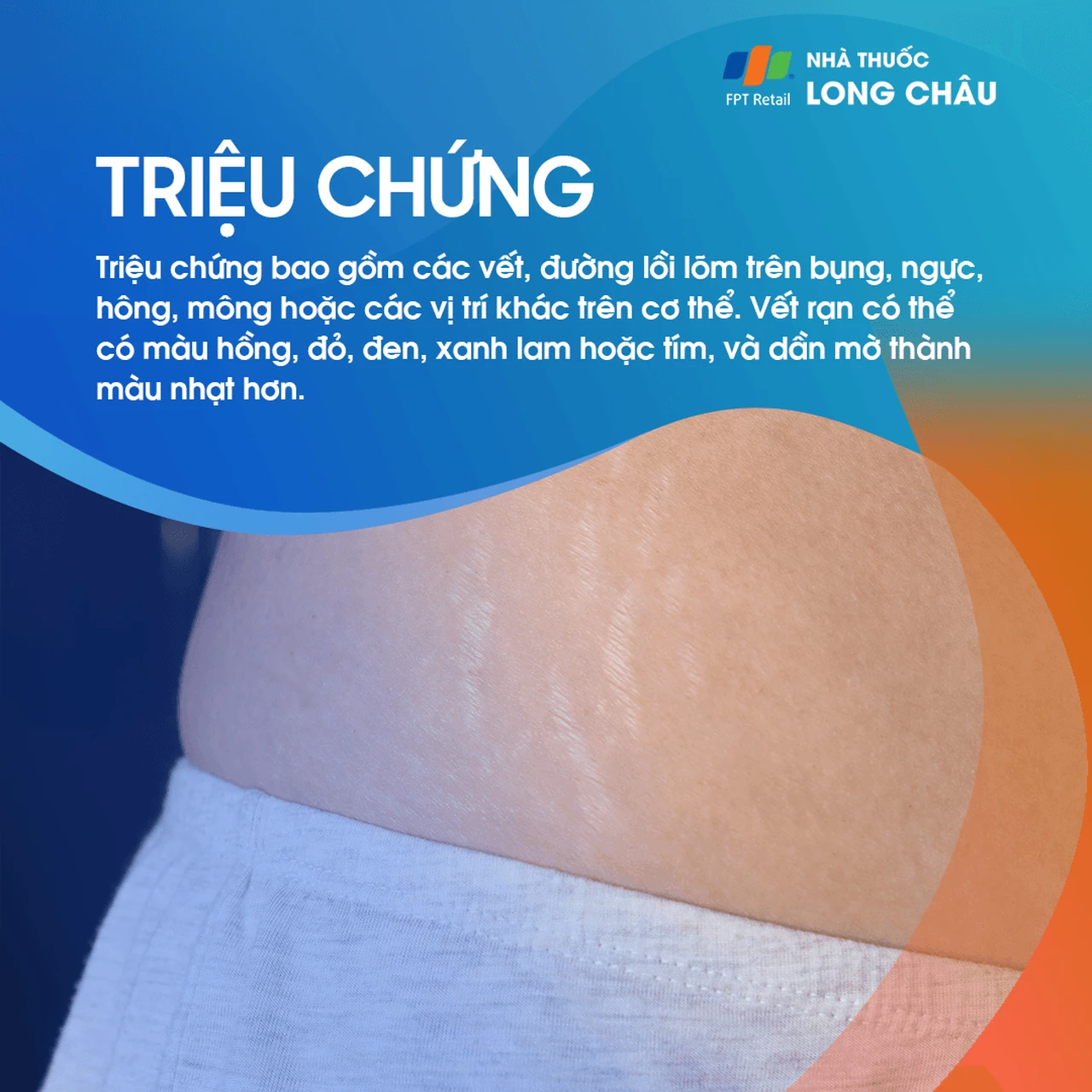 các vết rạn da đỏ hồng và trắng trên da bụng, điển hình ở phụ nữ mang thai