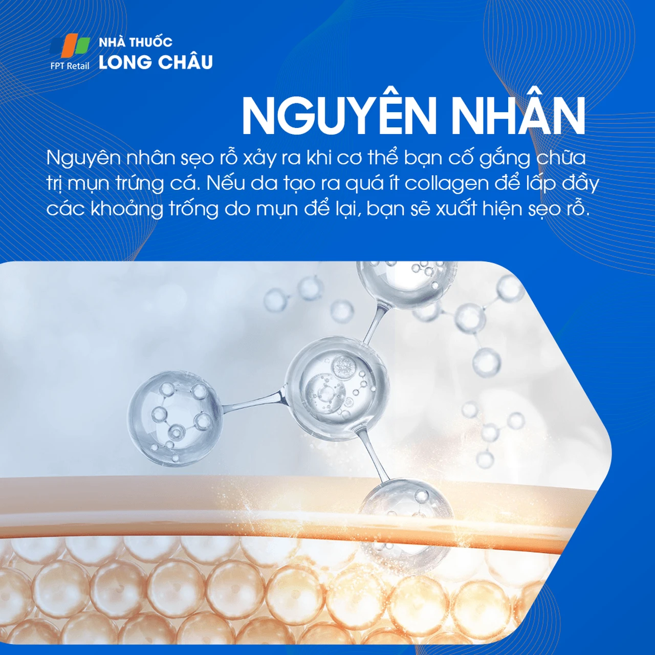 Nguyên nhân chính gây sẹo rỗ là do tổn thương tầng sâu của da, thường liên quan đến việc điều trị mụn không đúng cách