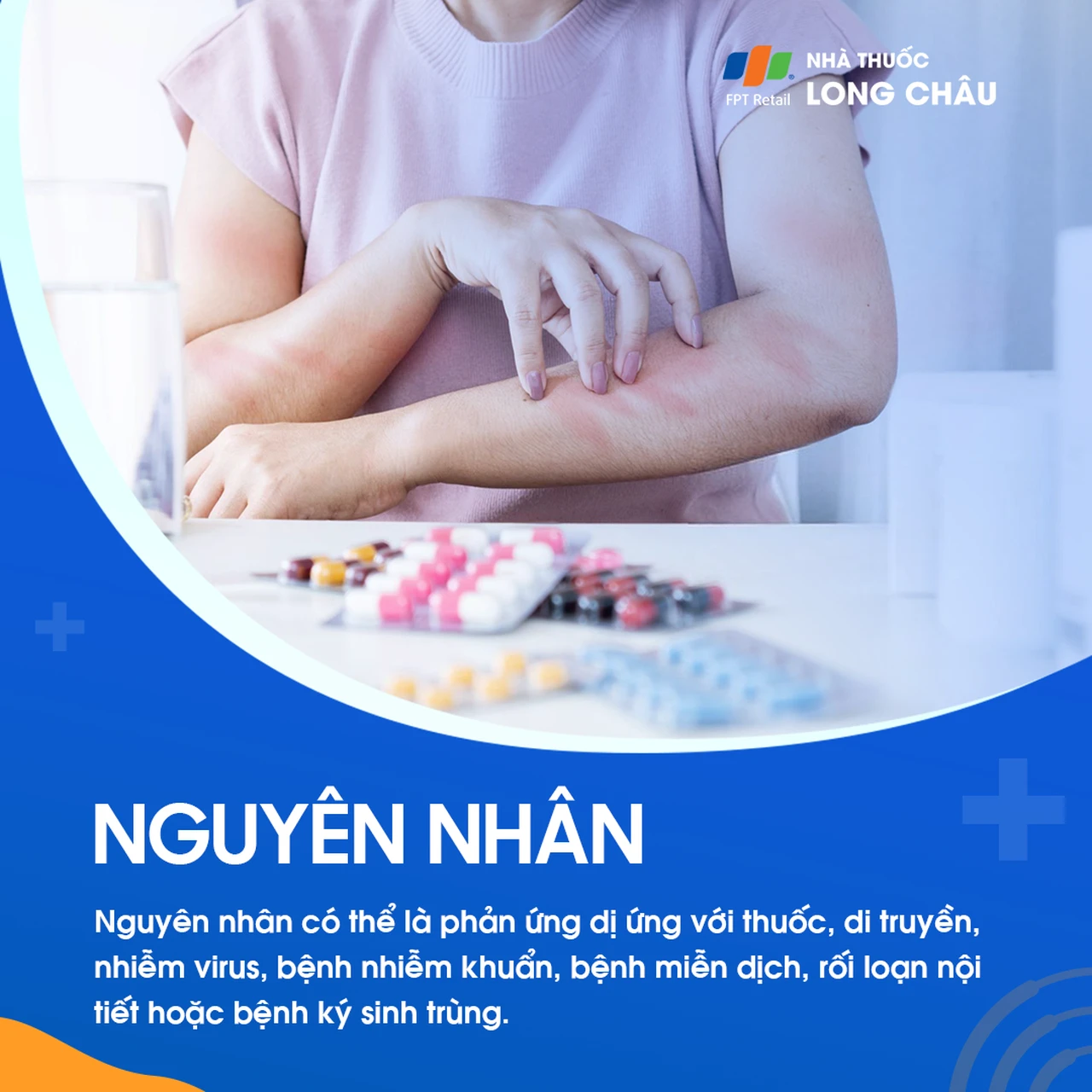 Hội chứng Stenven - Johnson 3