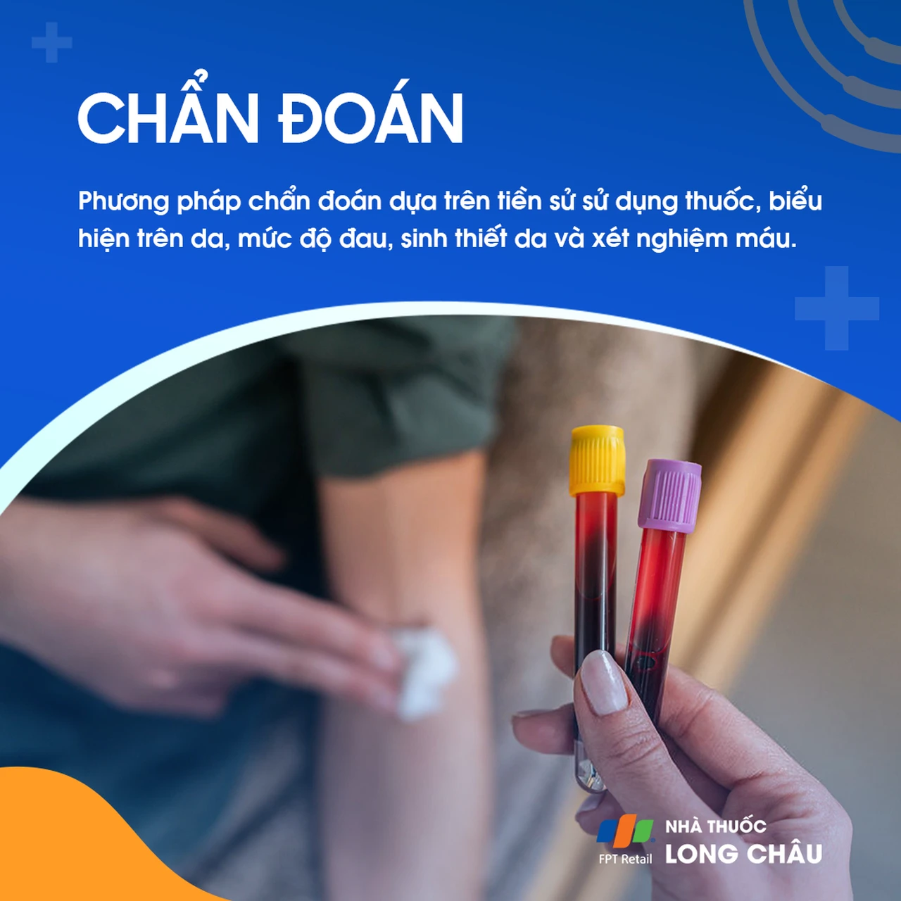 Hội chứng Stenven - Johnson 5