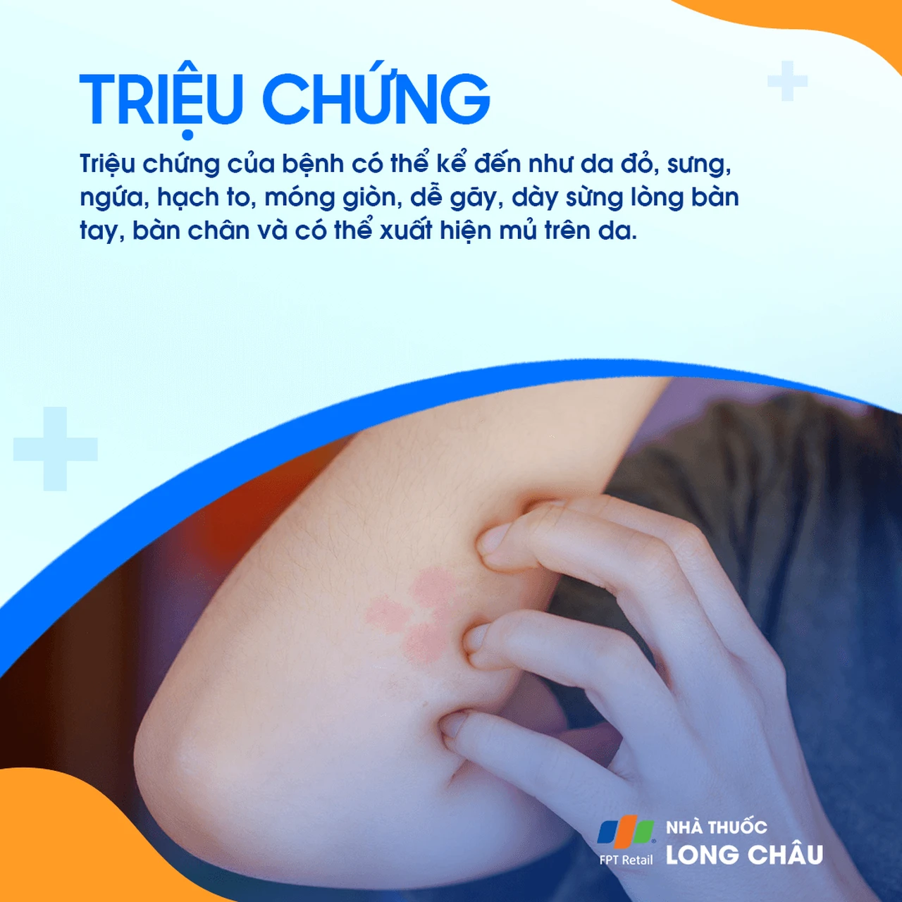 U sùi thể nấm 2