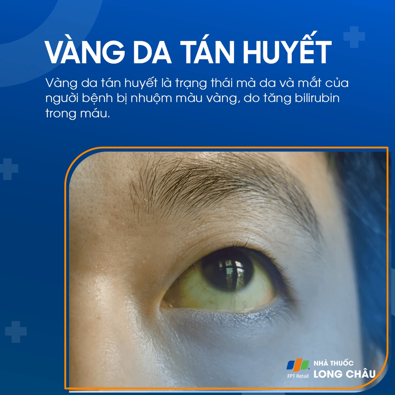 Vàng da tán huyết 1
