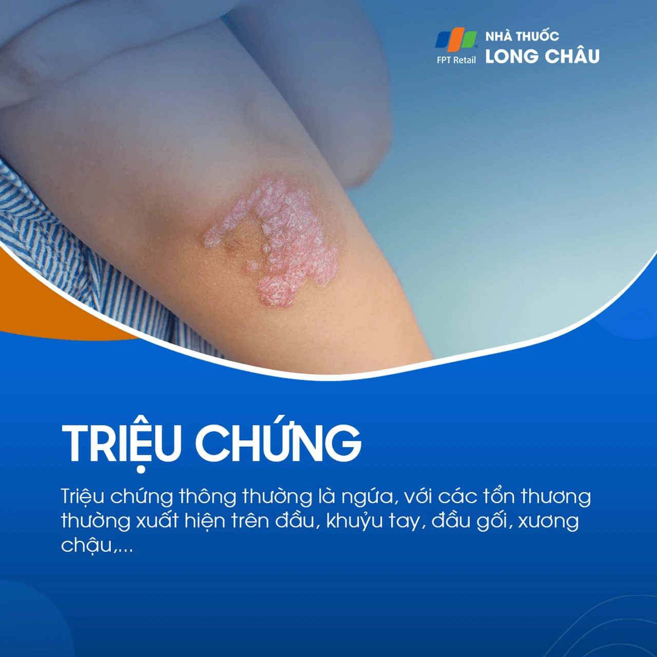 Triệu chứng thường gặp là ngứa, với tổn thương trên đầu, khuỷu tay, đầu gối, xương chậu