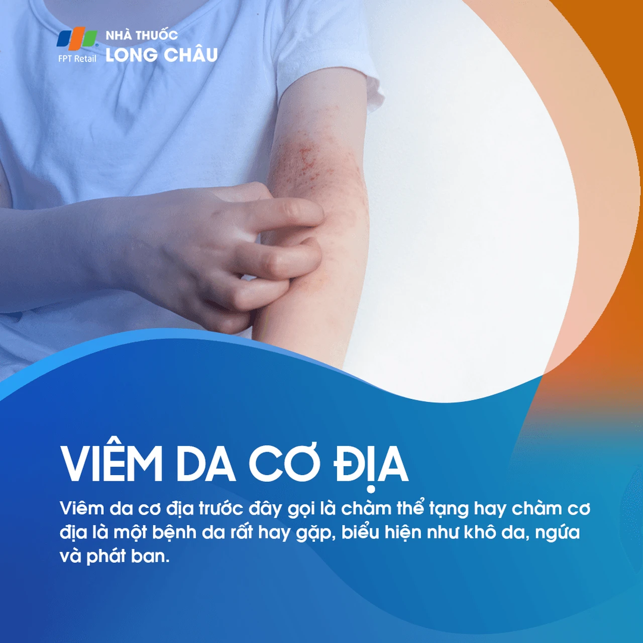 Viêm da cơ địa (eczema, chàm) là bệnh da mạn tính gây khô, ngứa, đỏ da