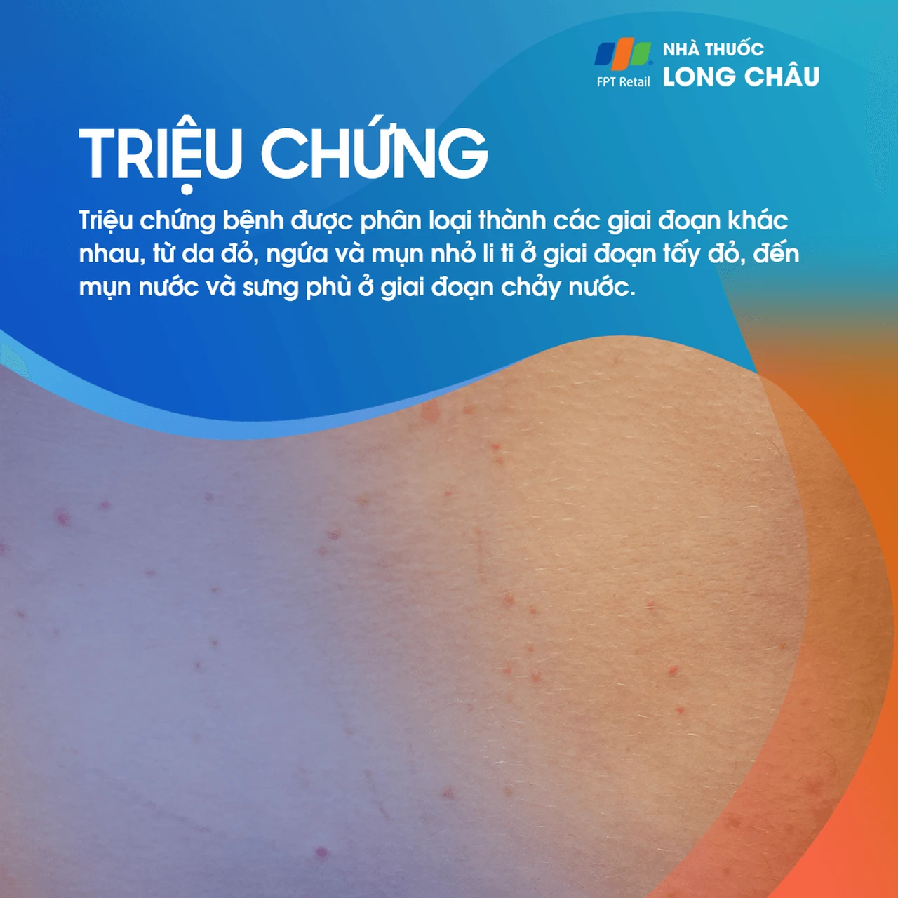 Triệu chứng viêm da cơ địa qua các giai đoạn phát ban và chảy nước