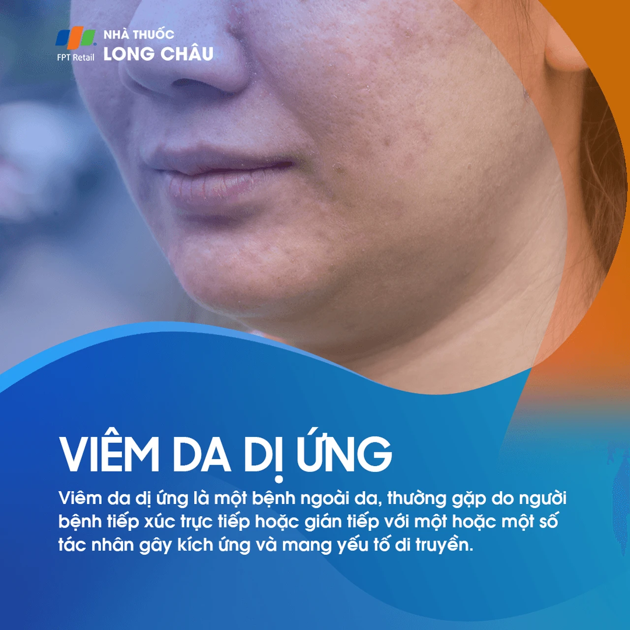 Viêm Da Dị Ứng 1