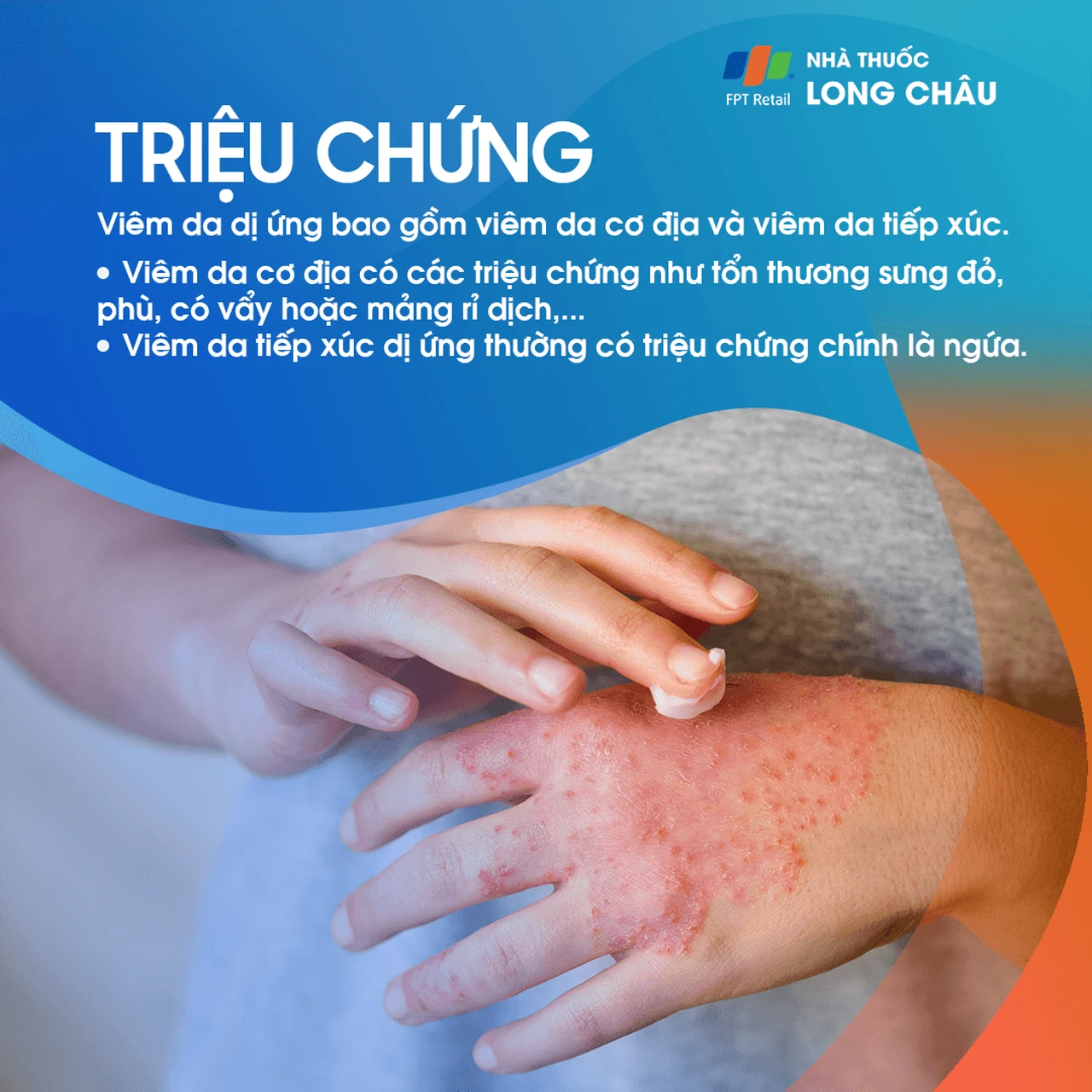 Viêm Da Dị Ứng 2